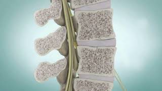 Spinal Stenosis and Spine Surgery  Medical Animation [upl. by Attelrahc499]