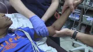 Posterior Elbow Dislocation Reduction [upl. by Fogg]