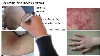 Dermatitis vs Eczema are they same Types of dermatitis symptoms prognosis and treatment [upl. by Zulch391]