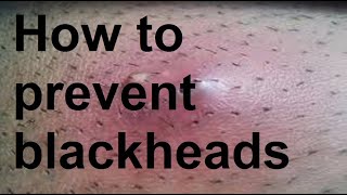 how to prevent blackheads [upl. by Lomax]