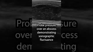 Sonographic Fluctuance pocus ultrasound abscess [upl. by Etteve216]