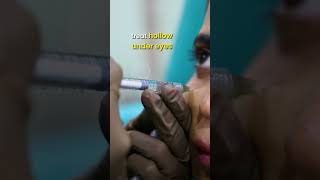 Dermal Fillers 💉🧏‍♀️ for Face lift Eyebrows and Scars  Dr Priyanka Reddy  DNA Skin Clinic [upl. by Eanil]