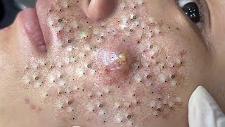 Big Cystic Acne Blackheads Extraction Blackheads amp Milia Whiteheads Removal Pimple Popping  167 [upl. by Acalia172]