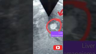 Liver Hemangiomasolitary liver nodulehyperechoic noduleultrasoundscanytshortusgshortvideo [upl. by Nedia]