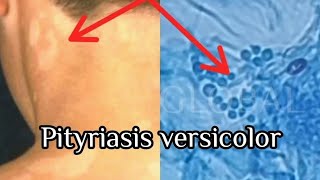 Pityriasis Versicolor under the microscope [upl. by Pietro]