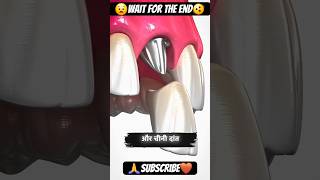 Bone Grafting Explained 🤔  bone grafting shorts shortsvideo shortsfeed [upl. by Macfarlane387]