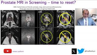 MRI in Prostate Cancer Screening  Time to Reset [upl. by Dubenko]