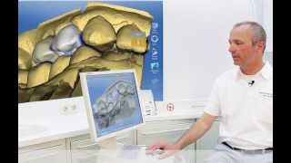 Tips amp Tricks  CEREC Dental Union [upl. by Eannaj]