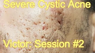 Severe Cystic Acne  Victor Session 2 [upl. by Alahsal442]