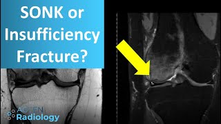 Why Spontaneous Osteonecrosis of the knee should not be used anymore [upl. by Felix]