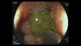 Subocclusion Treated by Colonic Stent Placement [upl. by Haron782]