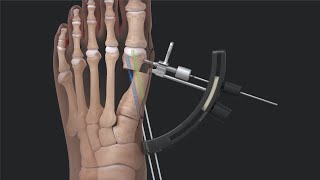 Arthrex Minimally Invasive Bunionectomy System Surgical Technique [upl. by Pansir]