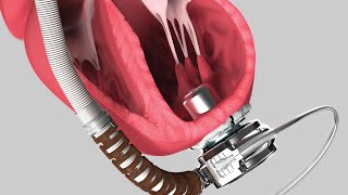 Medical Device Animation Heartware System LVAD Pump [upl. by Emalia]