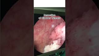 Endoscopic Removal of Bladder Tumor [upl. by Foscalina]