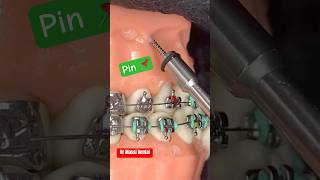 Dental Braces TADs [upl. by Settle]