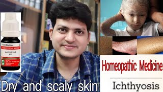 Ichthyosis  रूखी सूखी फटी हुई त्वचा  Homeopathic medicine for Ichthyosis  explain [upl. by Beatrix]