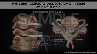 Anterior Cervical Discectomy amp Fusion at C45 amp C56 [upl. by Alrahs]