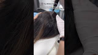 Calecim Advanced Hair System MicroNeedling at Dr MediSpa [upl. by Jessika]