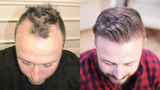 Hair Transplant Testimonial  Alan [upl. by Shanney]