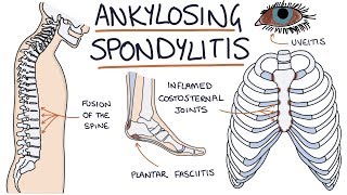 Ankylosing Spondylitis Visual Explanation for Students [upl. by Som]