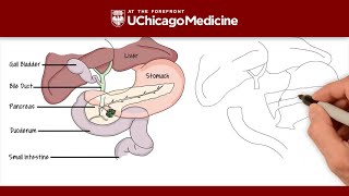 What is the Whipple procedure  UChicago Medicine [upl. by Assiluy]