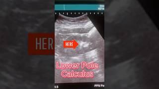 Renal Calculus ultrasound [upl. by Ymmit]