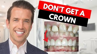 Watch this before getting a Dental Crown [upl. by Tyree]