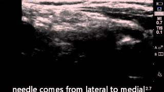 ULtrasound guided superficial cervical plexus block [upl. by Dow415]