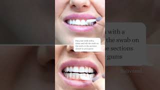 Enlighten  Teeth Whitening Process  London  Whites Dental [upl. by Adnihc]