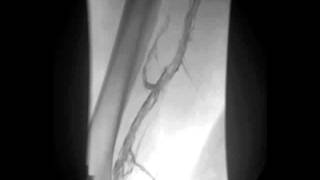 Leg Venographic Images Obtained before and after Thrombolysis [upl. by Ahcurb]