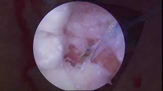 Modified Centralization Technique of Tibial Side Capsulodesis for Radial Tear of Incomplete Discoid [upl. by Verlee72]