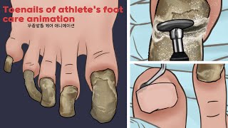 ASMR Satisfying Toenail of Athletes foot Treatment animation  Athletes foot foot care  TINGLES [upl. by Fari]