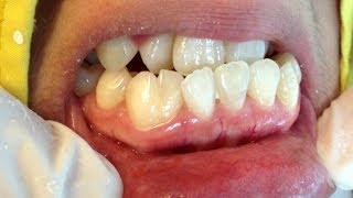 ฟันแฝด จัดฟันได้ไหม Fusion Teeth [upl. by Donela]