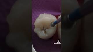 dentalcaries cavite dentist smiledental dentalsmiledesigning [upl. by Ariaet]