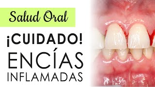 ¡¡CUIDADO CON LAS ENCÍAS INFLAMADAS  CAUSAS Y TRATAMIENTOS [upl. by Eniamzaj]