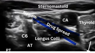 Stellate Ganglion Block for CRPS [upl. by Herbie707]