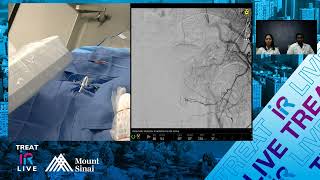 Transradial Prostate Artery Embolization using nBCA Glue for Benign Prostatic Hyperplasia BPH [upl. by Aromat]