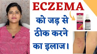 Eczema Treatment ॥ Skin Allergy और Eczema को जड़ से ठीक करने का इलाज ॥ [upl. by Annazor475]