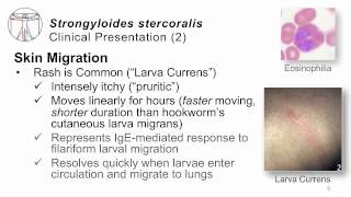 Helminths Strongyloides [upl. by Raffaello]