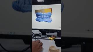 My 1st Denture Design in 3shape Software [upl. by Eelyek197]