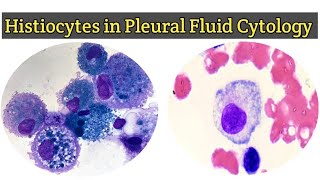 Histiocytes in Pleural Fluid for Cytology  Pleural Fluid Routine Examination [upl. by Celene]