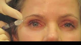 Filler Technique for Rejuvenation of the Upper Periocular Area [upl. by Eyllom]