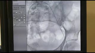 Thrombus aspiration and catheter directed thrombolysis Deepak Heart Institute [upl. by Opiak779]