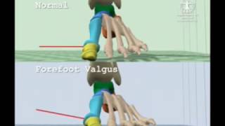 Comparison of Normal Gait to Forefoot Valgus Gait [upl. by Leontine195]