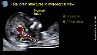 Open spina bifida at 1113 weeks gestation brainstem [upl. by Pattani]