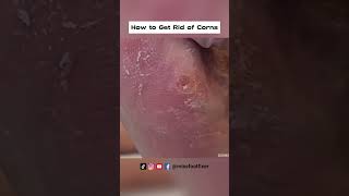 How to Get Rid of Corns on the Side of Your Foot By Foot Specialist Miss Foot Fixer [upl. by Joaquin954]