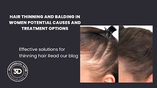 Are you struggling with hair thinning or baldness [upl. by Ignatius699]