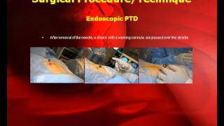 Posterolateral Endoscopic Thoracic Microdiscectomy with GPS System [upl. by Eenwahs16]