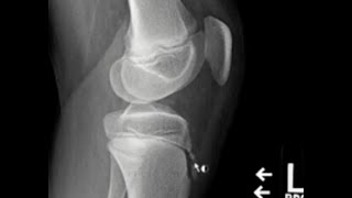 OsgoodSchlatter disease [upl. by Yumuk]