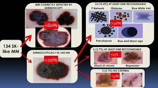 Seborrheic Keratosislike melanomas  Dr Cristina Carrera [upl. by Elleiand]